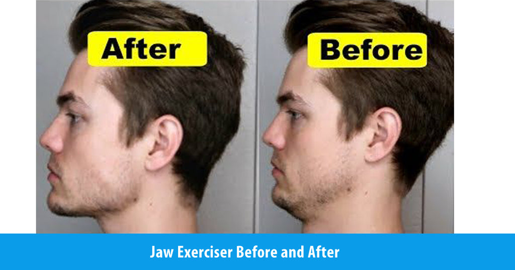Jaw Exerciser Before and After – JawFlex®
